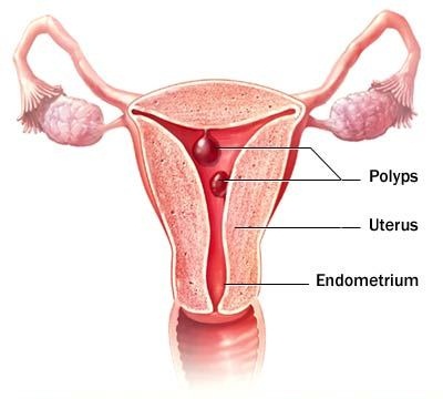 Bệnh polyp lòng tử cung ở phụ nữ là gì?