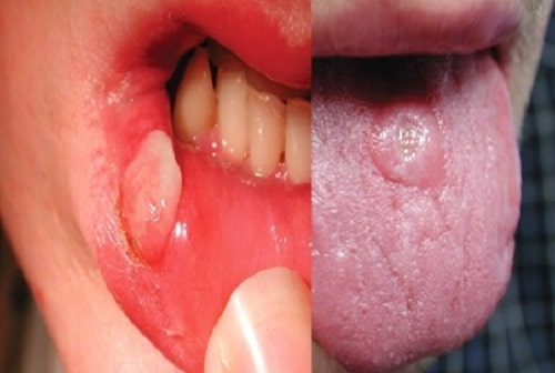 Hình ảnh bệnh giang mai ở miệng