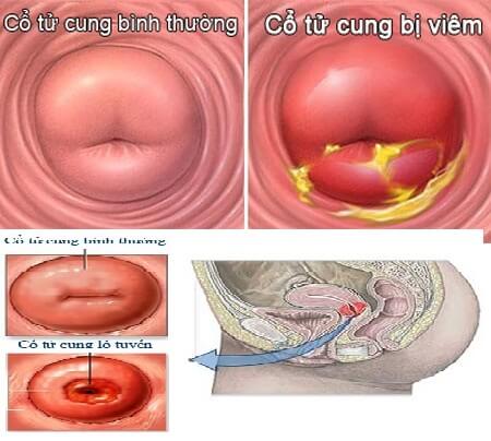 Viêm cổ tử cung và nguyên nhân viêm cổ tử cung