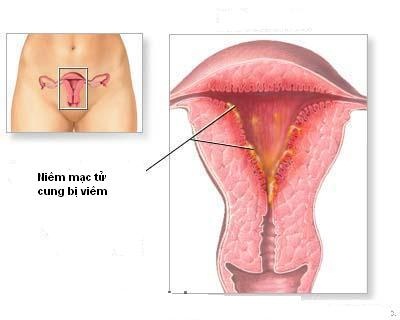 Dấu hiệu viêm nội mạc tử cung