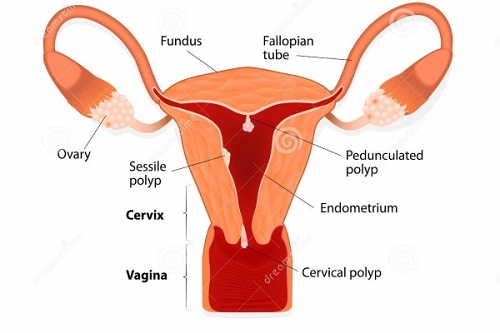 triệu chứng polyp cổ tử cung