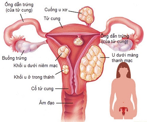 Bệnh u nang tử cung ở phụ nữ là gì?