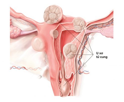 Bệnh u xơ tử cung ở phụ nữ tiền mãn kinh là gì?