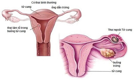 Nguyên nhân dẫn đến thai ngoài tử cung