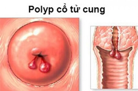 Cắt polyp tử cung là thủ thuật điều trị polyp tử cung