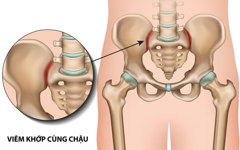 Hình ảnh viêm khớp cùng chậu