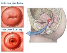 Bệnh viêm loét cổ tử cung là gì?