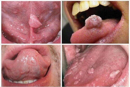 Hình ảnh của bệnh sùi mào gà ở miệng