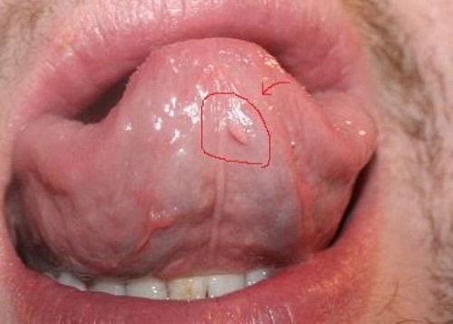 Hình ảnh sùi mào gà giai đoạn đầu ở miệng