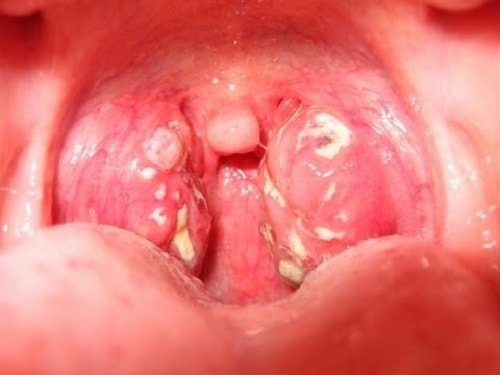 Bệnh lậu ở miệng có nguy hiểm không?