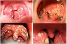 Hình ảnh bệnh lậu ở miệng