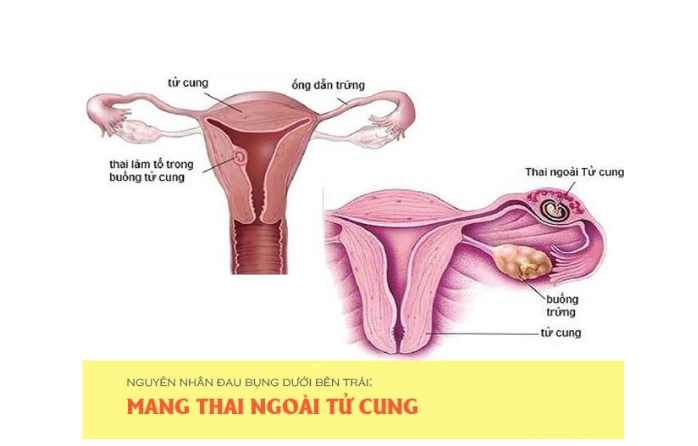 Mang Thai Ngoai Tu Cung