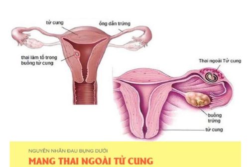 Đau bụng dưới do mang thai