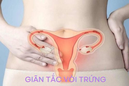 Giãn tắc vòi trứng là gì? Giãn tắc vòi trứng có gây vô sinh?