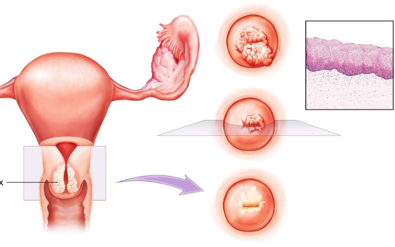 Bác sĩ ơi viêm tái tạo cổ tử cung là gì? có nguy hiểm không?