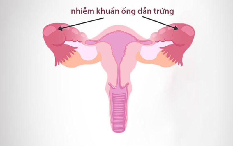 Nguyên nhân tắc vòi trứng có thể do viêm nhiễm phụ khoa