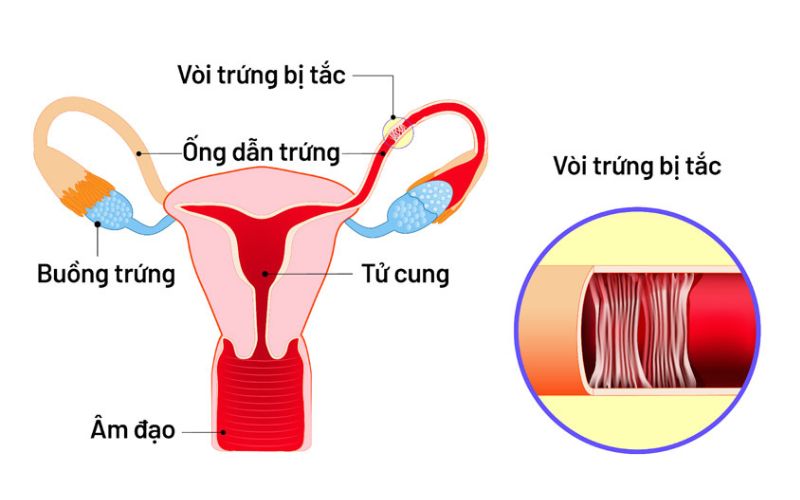 Tắc vòi trứng là nguyên nhân hiếm muộn nữ hàng đầu