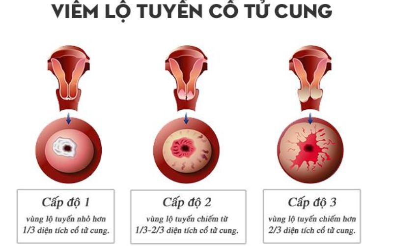 Hình ảnh viêm lộ tuyến cổ tử cung độ 2